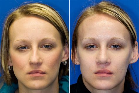 Crooked Nose Rhinoplasty In Seattle