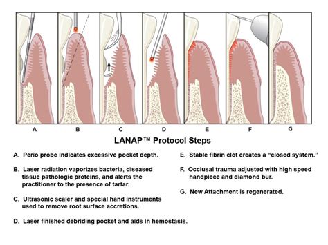 Lanap® Laser Gum Treatment Westerly Ri New London Ct