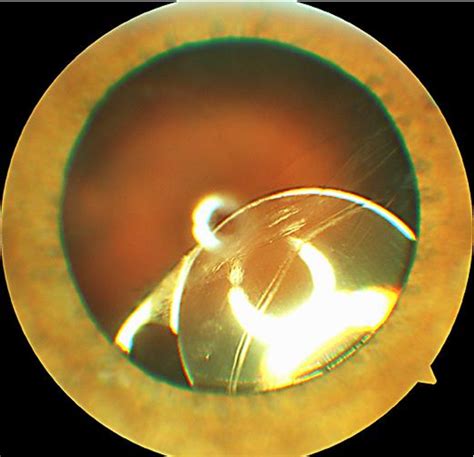 Figure 2 from Anterior Chamber Iris Claw Lens for the Treatment of ...