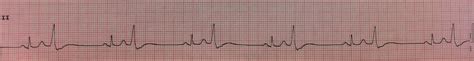 Benign PVCs: A heart rhythm doctor’s approach.