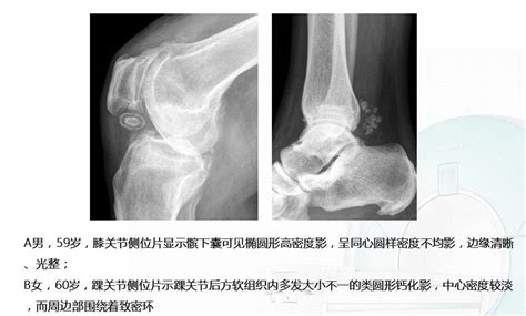 大关节痛风性关节炎的诊断及鉴别诊断 好医术早读文章 好医术 赋能医生守护生命