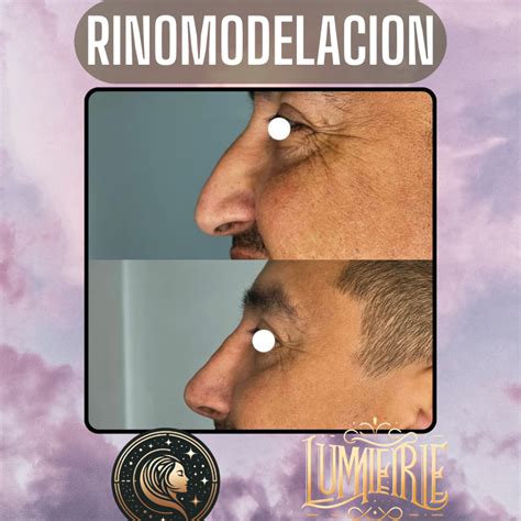 Rinomodelación con Ácido Hialurónico Clinica Estetica Lumière