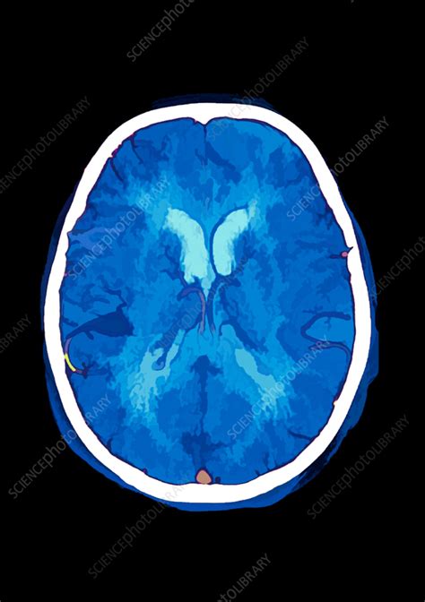 Cerebral Arteries Ct Scan Stock Image C Science Photo