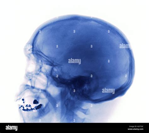 X-ray of a skull fracture Stock Photo - Alamy