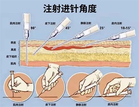 以前常打的屁股针，怎么现在很少见了？三角肌臀大肌臀中肌臀小肌屁股少见注射部位大腿肌肉护理 健康界