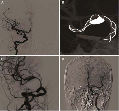 Frontiers Case Report Tubridge Flow Diverter For A Ruptured Fusiform