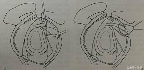 肩關節不穩臨床篇：關節鏡修復技術——骨醫小灶第二十期（中） 每日頭條