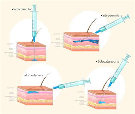 Diagramme Des Types D'injections | Vecteur Gratuite