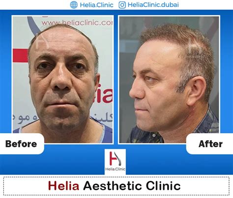 Fut Hair Transplants Cost Benefits And Recovery Helia Clinic