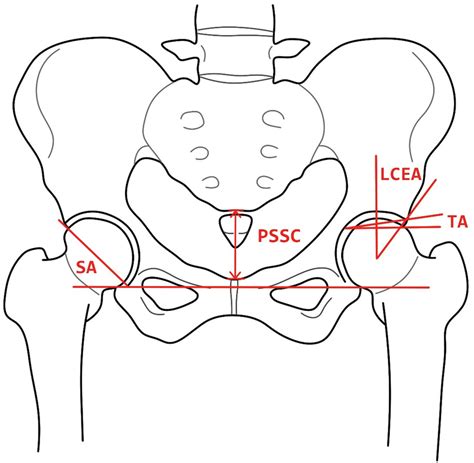 Anteroposterior Ap Pelvic Radiograph In Standing Position Is Shown Download Scientific