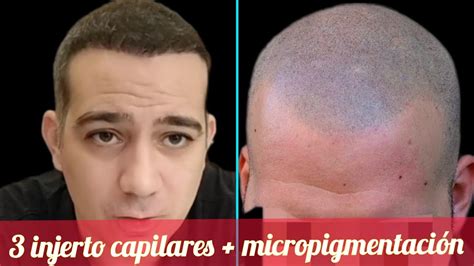 Injerto Capilares Micropigmentaci N Por Fin Youtube