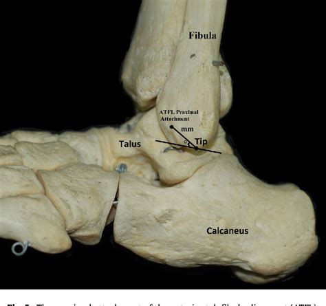 Anterior Talofibular Ligament Pasaacme