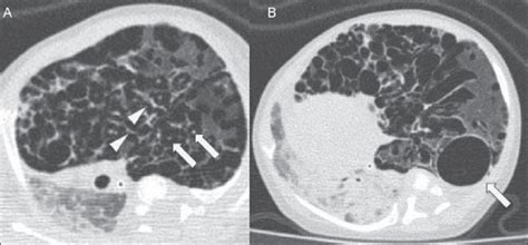 Axial Chest Computed Tomography A Multiple Cystic Predominantly