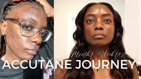 ACCUTANE JOURNEY MONTH 1 WEEK 1 2 ON ISOTRETINOIN HOW I CURED MY