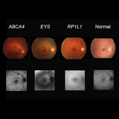 Prediction Of Causative Genes In Inherited Retinal Disorder From Fundus