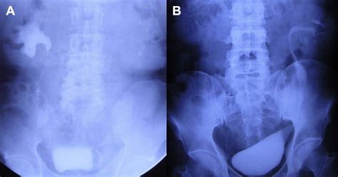 Reconstructing Full Length Ureteral Defects Using A Spiral Bladder