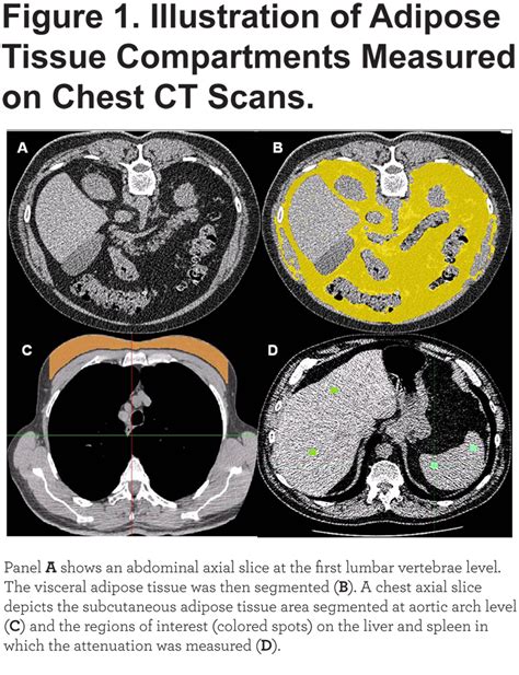 Visceral Fat And Myocardial Infarction In Copd Journal Of Copd