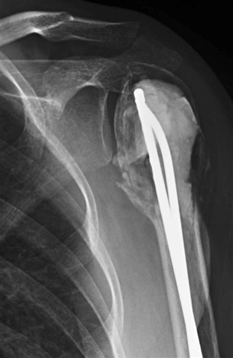 Current Concepts Of Shoulder Arthroplasty For Radiologists Part 1epidemiology History