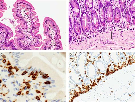 Histologic Findings In Duodenal Mucosa Sections From Ncgs Patients