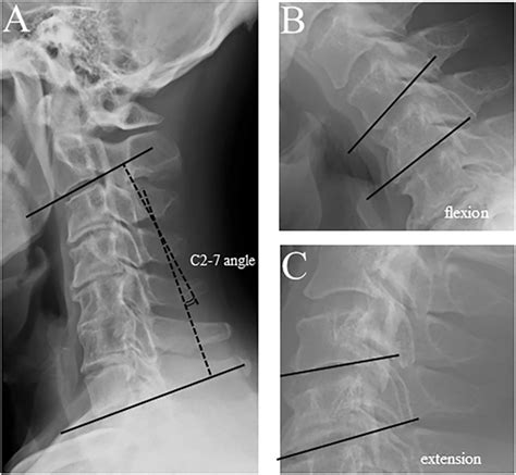 Measurement Of C2 7 Angle And Range Of Motion C2 7 Angle Was Measured
