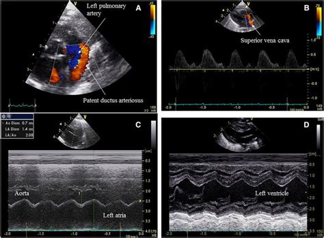 A Colour Doppler Showing A Patent Ductus Arteriosus And Left Pulmonary Download Scientific