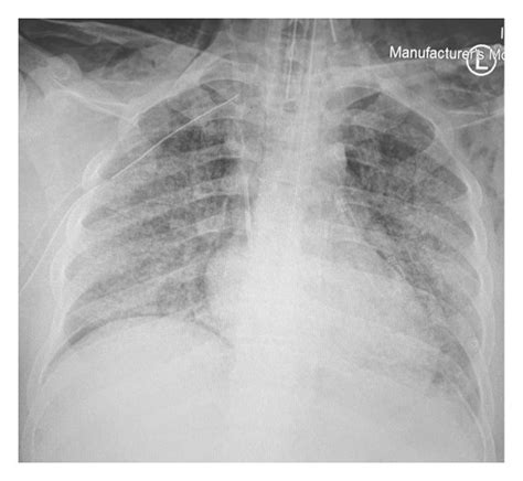 Admission Chest X Ray Showing Bilateral Extensive Ground Glass