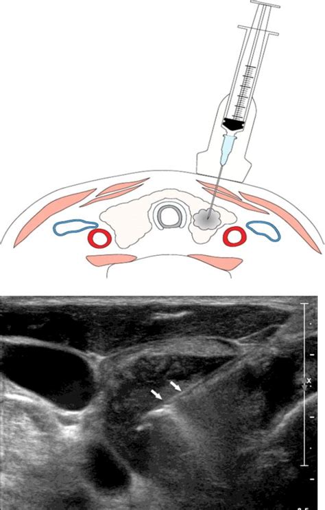 Table 1 From Ultrasound Guided Fine Needle Aspiration Biopsy Of Thyroid Nodules Our Experience