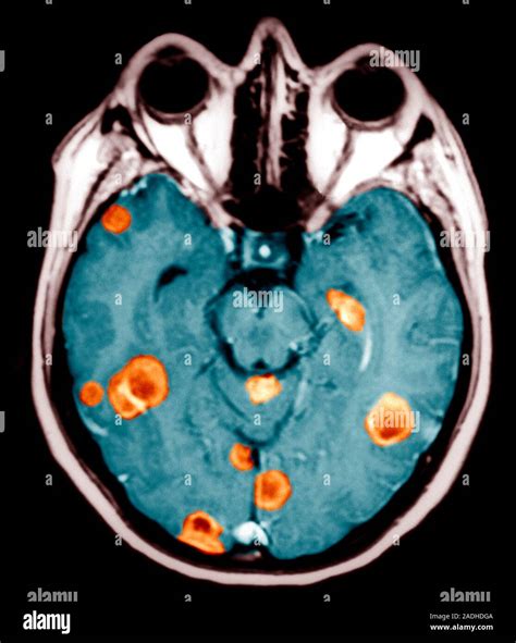 El Cáncer Cerebral Axial Coloreada Horizontal La Imagen Por Resonancia Magnética Mri Por