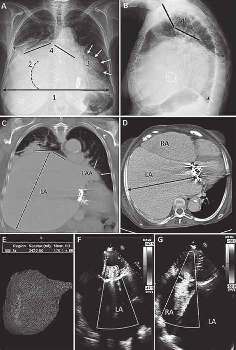 Fig Chest X Ray In Frontal A And Lateral View B And Correspondence