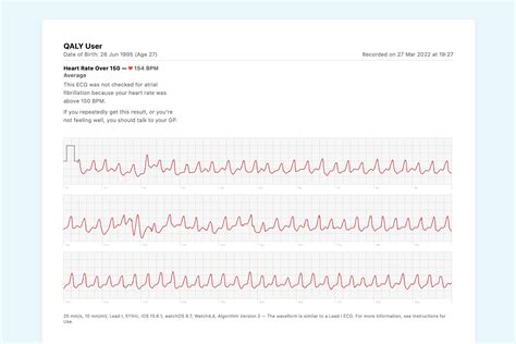 Ventricular Tachycardia Ecg