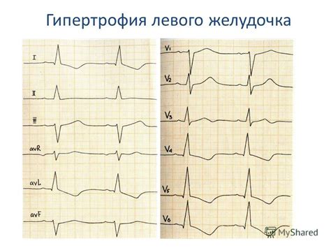 Презентация на тему: "РЕВМАТИЗМ ПРИОБРЕТЕННЫЕ ПОРОКИ СЕРДЦА доц. Б.А ...