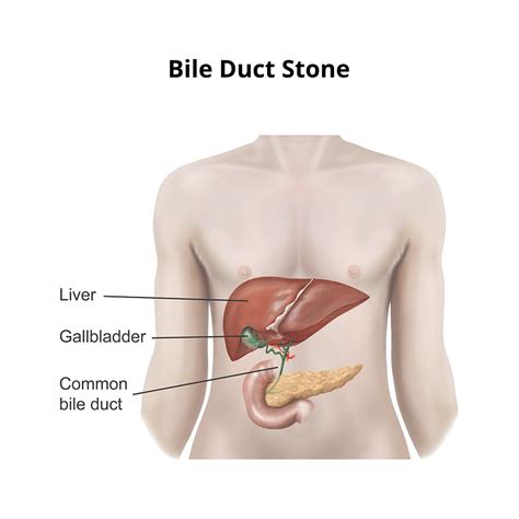 Common Bile Duct Stones Symptoms Diagnosis And Treatment Dr Vikas