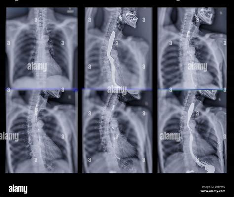 Prueba De Estudio De Swallow De Bario Diagnosticar Examen Del Tracto