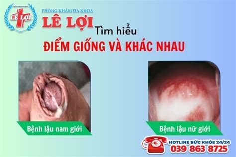 Tìm hiểu về 4 dấu hiệu sùi mào gà ở nam giới không nên chủ quan