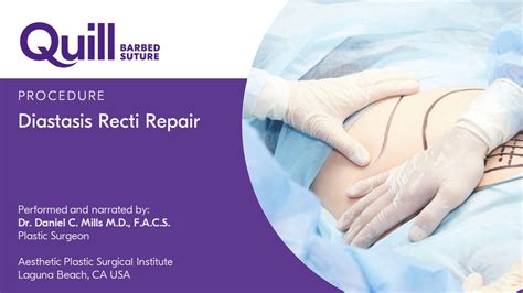 Diastasis Recti Repair By Dr Daniel C Mills Corza Medical Global