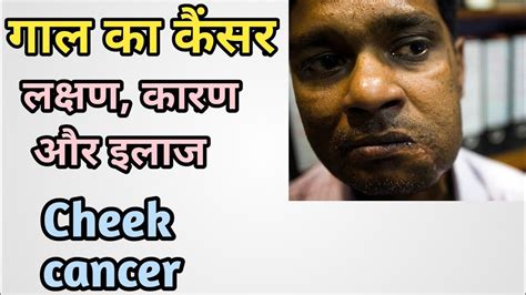 गाल का कैंसर क्यों और कैसे होता है इसका इलाज क्या है Cheek Cancer