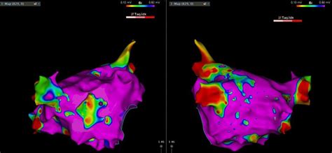 Left Atrial La Electroanatomical Maps Created During Sinus Rhythm