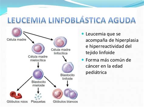 Leucemia Linfoblástica Aguda En Pediatría