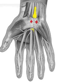 Le Syndrome Du Canal Carpien Dr Garrigues Neurologue Emg Narbonne