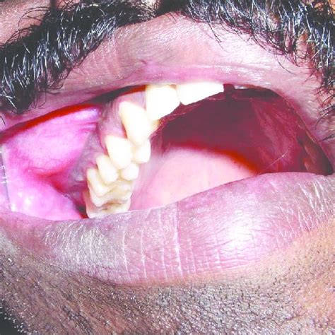Intraoral Photograph Showing Well‑defined Swelling Extending From The