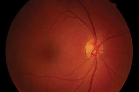 A Case Of Poppers Maculopathy