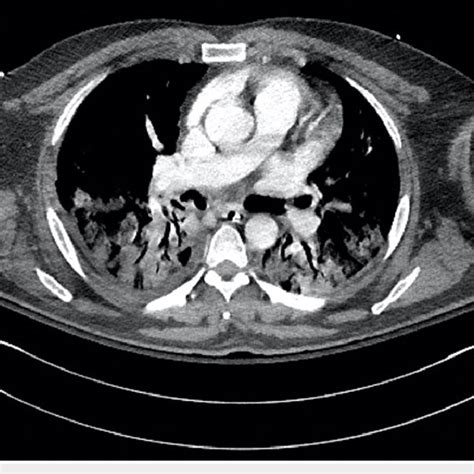 CT Chest Angiography Significant For Multiple Segmental And