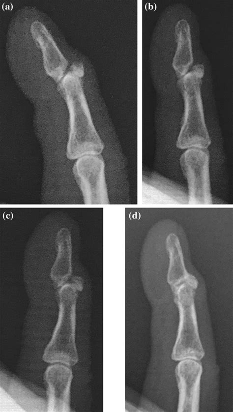 The first case (No.6) was 56-year-old female with systemic lupus ...