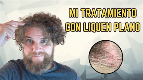 Tratamiento Del Liquen Plano Los Consejos De Michael