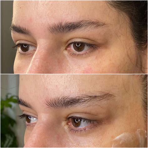 Fox Eye Thread Lift London Sas Aesthetics