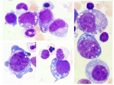 Precursores Medulares Vacuolados En S Ndrome De Vexas Una Nueva