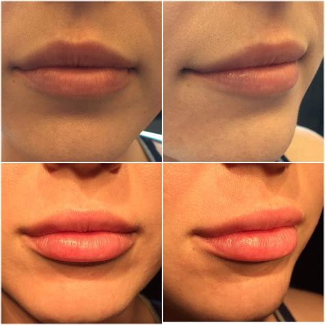 Juvederm Lips Before And After Syringe