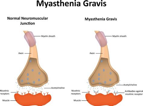 Raising Awareness Of Myasthenia Gravis And Those Living With It