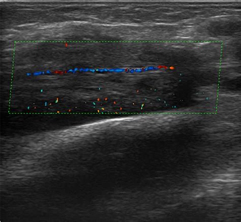 Figure 10 From A Bump What To Do Next Ultrasound Imaging Of