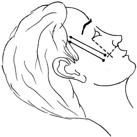 Caudal To The Inferior Border Of The Zygomatic Bone And Lateral To The